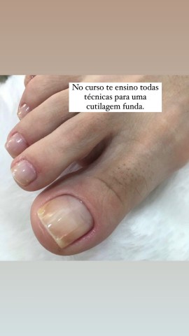 Aprenda as melhores técnicas para cutilagem funda.
